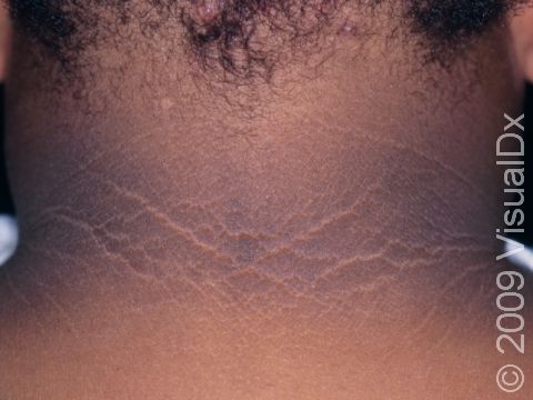 The neck displays the skin thickening and dark color of acanthosis nigricans.