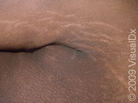 In addition to the subtle darkening and thickening of the armpit skin caused by acanthosis nigricans, striae (stretch marks) can be seen.