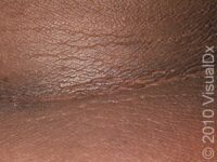 Acanthosis Nigricans – Adult