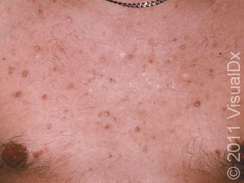 Scars displayed as dark spots (hyperpigmentation) with virtually no active acne on the chest are a sign that the patient is picking and squeezing the lesions.