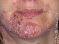 Acne Excoriée