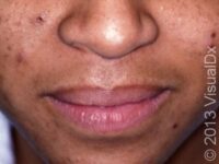 Acne Excoriée