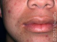 Acne Excoriée