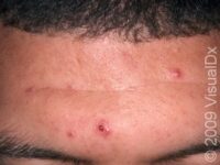 Acne Excoriée