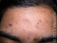 Acne Excoriée