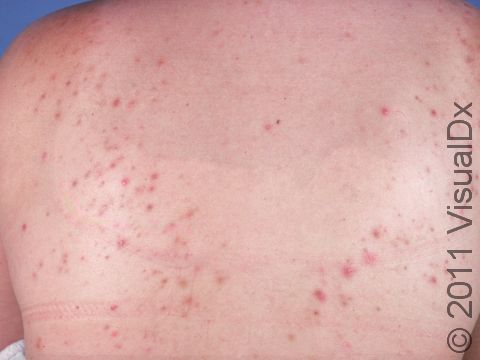 Acne frequently affects the back. This image shows a mix of red bumps, cystic acne, comedones (