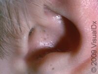 Acne (Acne Vulgaris)