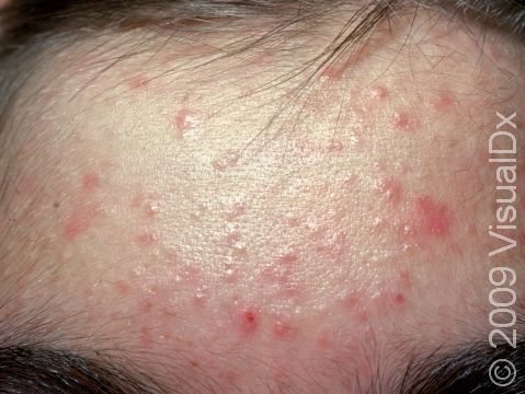 This patient has numerous whiteheads (closed comedones) as well as red, inflammatory acne bumps on the forehead.