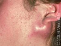 Acne (Acne Vulgaris)