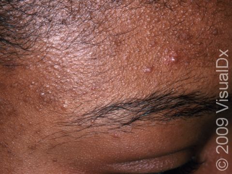 This image displays numerous whiteheads (closed comedones) and acne pus-filled lesions on the forehead.