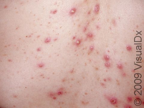 Close-up of pustules and inflammatory skin lesions of acne.