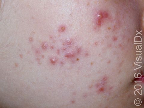 This image displays small bumps, pus-filled lesions, and residual flat, red marks typical of acne.