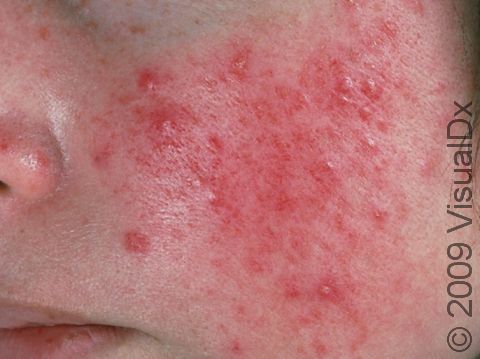 This image displays the overall redness of the cheeks with accompanying red bumps typical of inflammatory acne.