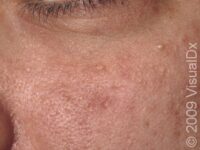 Acne (Acne Vulgaris)