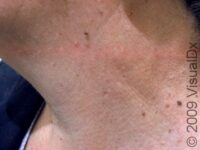 Skin Tag (Acrochordon)