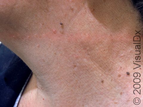 Do Skin Tags Need to Be Removed? Here’s When to See a Doctor