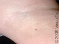 Skin Tag (Acrochordon)