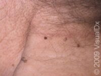 Skin Tag (Acrochordon) – Adult