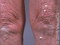 Actinic Keratosis (Solar Keratosis)