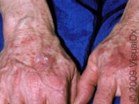 Actinic Keratosis (Solar Keratosis) – Adult