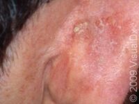 Actinic Keratosis (Solar Keratosis)