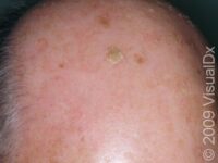Actinic Keratosis (Solar Keratosis)