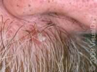 Actinic Keratosis (Solar Keratosis)