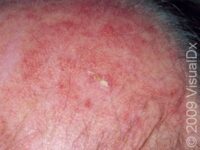 Actinic Keratosis (Solar Keratosis)