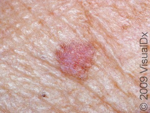 This image displays a close-up of actinic keratoses.