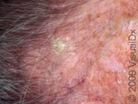 Actinic Keratosis (Solar Keratosis)