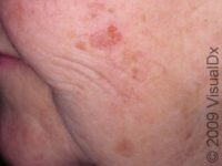 Actinic Keratosis (Solar Keratosis)
