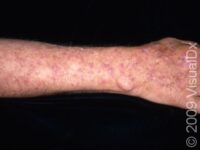 Actinic Keratosis (Solar Keratosis)