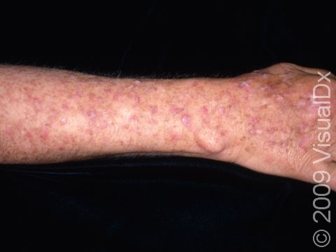 The forearm is a very common area for sun damage and actinic keratoses.