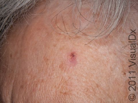 While the rough, gritty scale of actinic keratoses is sometimes easier to feel than see, it can also be very obvious to the naked eye as with this lesion on the forehead.