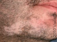 Hair Loss (Alopecia Areata)