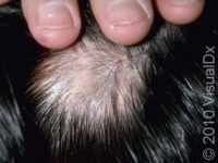 Hair Loss (Alopecia Areata)