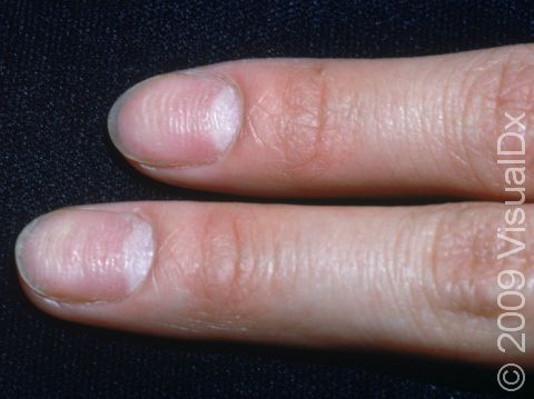 This image displays nail pits and ridges typical of alopecia areata.