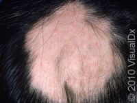 Hair Loss (Alopecia Areata)
