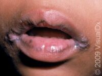 Angular Cheilitis – Adult