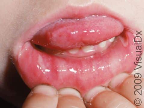 There are aphthous ulcers (canker sores) on the right of the image at the corner of the mouth, just below the tongue, and also a shallow ulcer on the lower lip on the left.