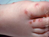 Bug Bite or Sting