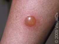 Bug Bite or Sting