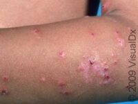 Bug Bite or Sting