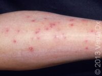 Bug Bite or Sting