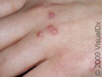 Bug Bite or Sting