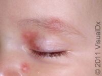 Bug Bite or Sting