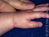 Bug Bite or Sting (Pediatric)