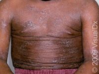 Eczema (Atopic Dermatitis) – Child