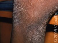 Eczema (Atopic Dermatitis)
