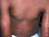 Eczema (Atopic Dermatitis)